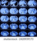 Small photo of CT scan of HBS and Pancreas (Contrast): Solitary, non enhancing, hypodense lesion having ill defined margin noted. Atypical hemangioma or vascular malformation or mitotic lesion.