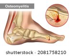 osteomyelitis is an infection... | Shutterstock .eps vector #2081758210