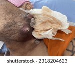 Small photo of a case of skin cancer , abscess , pock , ulcer.