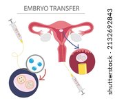 Illustration Of Embryo Transfer ...