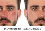 Small photo of Before and after a treatment for acneiiform rosacea in a male face. Coupery on the cheeks and nose of a young man