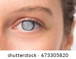 Eye Of Young Girl With Cataract