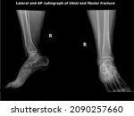 Small photo of Tibia Comminuted fracture.Distal fibula and tibia fracture showed by radiograph,X-ray. 70 year old woman falling down a ladder. she will go under surgical operation.