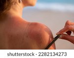 sunburned skin. sunburn skin. sun burn skin. closeup. The concept of sunburn. burnt skin in the sun. close-up. Damaged skins.