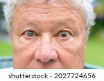 Small photo of Senior man with anisocoria showing unequal dilation of his pupils in a close up view on his eyes as he stares into the lens caused by disease, trauma or brain tumour