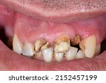 Small photo of Dentistry clinic case of a patient with oral disease located in the central incisor because of dental decay and bad hygiene. Broken teeth located in the anterior sector with aesthetic problem.