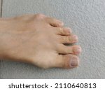 Small photo of initial signs of tailor's bunion foot deformity