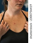 Small photo of Young 30s caucasian female examines ulcerated open wound of superficial basal cell carcinoma showing red discoloration on her chest.