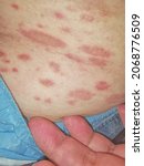 Small photo of PR Pityriasis rosea is a skin disease. It is assumed that it may be caused by a virus. which cannot be clearly proven
