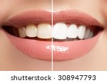 Perfect smile before and after bleaching. Dental care and whitening teeth