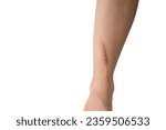Small photo of Woman leg blistered and red skin from accidental scalds on white isolate background.