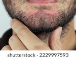 Small photo of Seborrheic dermatitis in the beard. Eczema on male face close up.