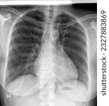 Small photo of chest X-ray image demonstrating the trachea, bronchi, and lung parenchyma, useful for assessing lung diseases such as bronchitis, asthma, or chronic obstructive pulmonary disease (COPD).