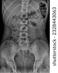 Small photo of Detailed X-ray image of the KUB region, revealing the bony structures of the pelvis along with the urinary organs, aiding in the assessment of urinary tract conditions.