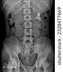 Small photo of Detailed KUB X-ray revealing the presence of renal calculi (kidney stones), assisting in the evaluation of stone size, location, and potential complication