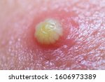 Small photo of Close-up macro Inflammatory acne and acne White pus on the face. Inflammatory Purulent acne closeup on face of young man asian. Purulent pimple on the skin on the face.The concept of skin problems.