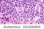Small photo of Photomicrograph of a lymph node in a patient with Hodgkin's Disease (lymphoma), showing a Reed Sternberg cell variant.