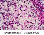 Small photo of Stomach (gastric) cancer histology: Microscopic image of a poorly differentiated gastric adenocarcinoma, signet ring cell type (photographed and uploaded by US board-certified surgical pathologist).