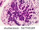 Small photo of Breast Cancer Awareness: Microscopic image (photomicrograph) of core biopsy for infiltrating (invasive) ductal carcinoma, detected by screening mammogram. H & E stain.