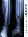 Small photo of Film x-ray leg (AP , Lateral view) : Comminuted fracture middle 1/3 of tibia and distal 1/3 of fibula