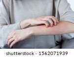 Small photo of Closeup girl is scratching her hand with nails. Reddened, inflamed body parts causes discomfort and itching. Young woman is suffering from bouts of allergies. Dermatological skin diseases concept.