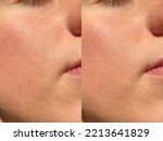 Small photo of Compare before and after (retouch photo) of close up wide large pores skin on oily face have pimple. Effect after use cream or treatment for facial care face skin to better