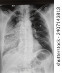 Small photo of Chest X-ray PA view showed opacities at right middle and whole of lower lobe of right lung with minimal pleural effusion at right middle lobe