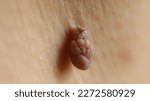 Small photo of Close up - A harmless polypoid outgrowth, also known as a skin tag or acrochordon, grows close to the armpit of a male patient. Hangs from a small stalk or peduncle.