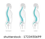 Spinal Deformity Flat Vector...