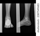 Small photo of Ankle joint x-ray image ap and lateral view