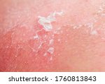 Small photo of background with the texture of irritated reddened skin with flaking cell scales after sunburn and allergies on the human body