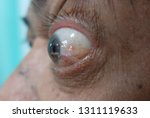 Small photo of Exopthalmos or prorotosis described as protrusion of the eyeball