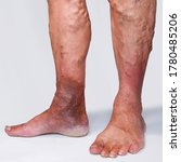 Small photo of People suffering from varicose veins often come to the phlebologists office, too late - at the moment when visible signs have already appeared on their legs: swelling, swollen veins, "stars".