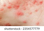 Small photo of Acne: Acne is a common skin condition caused by the overproduction of oil by the sebaceous glands. It leads to the formation of pimples, blackheads, whiteheads, and cysts, primarily on the face, back