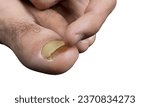 Small photo of onychomycosis concept.Nail infections caused by fungi such as: onychomycosis also known as tinea unguium. Thumb infection. Caused by dermatophytes and yeasts and concomitant antibacterial activity