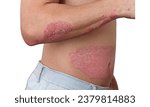 Small photo of Acute psoriasis on the skin ,body , is an autoimmune incurable dermatological skin disease. Large red, inflamed, flaky rash on the skin. Joints affected by psoriatic arthritis.white background
