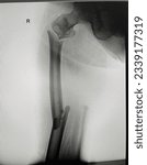 Small photo of Film Right Femur AP position. Segmental fracture of right proximal femur with displacement.