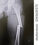 Small photo of Film x-ray left Femur show comminuted fracture of left femur with displacement and overriding.