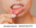Small photo of a close-up photo of a young woman showing an ulcer of stomatitis in the acute stage on the mucous membrane of the mouth.