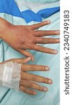 Small photo of hand scald wound, Hand, scald wound, wound,Scald treatment