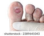 Small photo of This close-up photo vividly reveals the severity of a foot ulcer—an infected wound demanding urgent attention. A stark depiction urging awareness on diabetic foot care and healthcare initiatives.