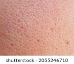 Small photo of Macro photo of big pore on oily facial skin type