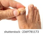 Small photo of Big toe cracked by toenail fungus