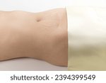 Small photo of Caesarean section surgical scar on a white background