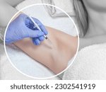 Small photo of The doctor makes intramuscular injections of botulinum toxin in the underarm area against hyperhidrosis. Cosmetology skin care