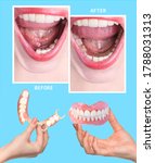 Small photo of Dental rehabilitation with lower flexible nylon denture, before and after treatment. Removable dentures flexible, devoid of nylon, hypoallergenic exempt from monomer