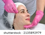 Thread lifting. Tightening of flabby skin in the jaw area with the help of cosmetic threads. Thread lifting. Tightening of flabby skin in the jaw area with the help of cosmetic threads.