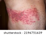 Small photo of Skin lesion symptom in Shingles or Herpes zoster in human. Shingles or Herpes zoster is aviral disease caused by varicella zoster virus charatrized by a painful skin rash with blisters on the body.