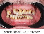 Small photo of Chronic generalized Paradontitis. Severe Periodontal disease or Periodontitis or severe Gum disease. Dentist office. Wedge-shaped defect. Smoker's plaque