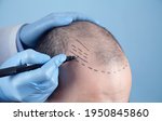 Small photo of Patient suffering from hair loss in consultation with a doctor. Doctor using skin marker
